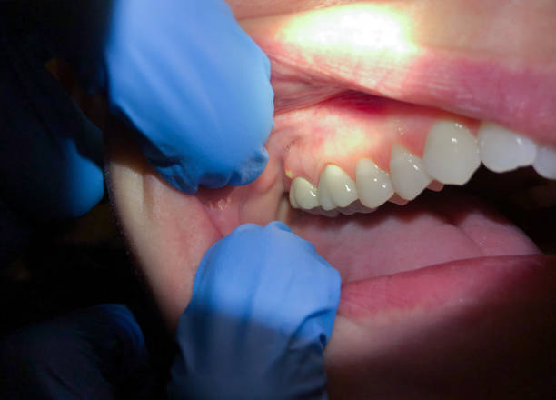 Best Dental Abscess Treatment in Surf City, NJ